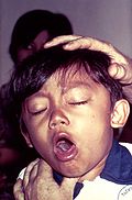 Whooping cough outbreak kills ten infants in California 