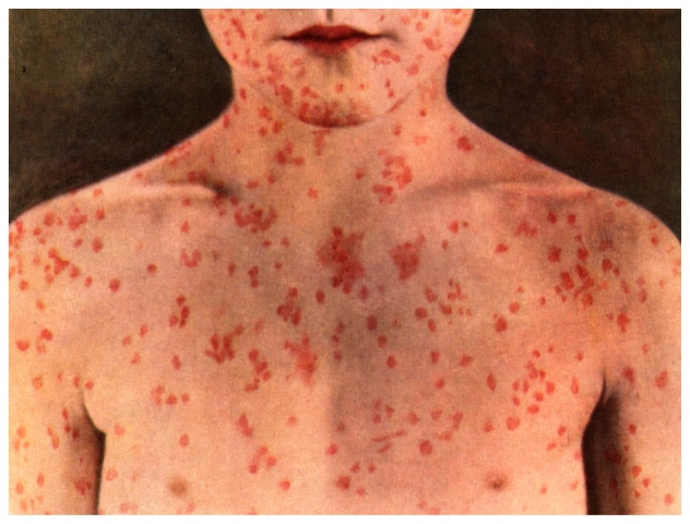 Interior Health closely monitoring outbreak of measles in Fraser Valley