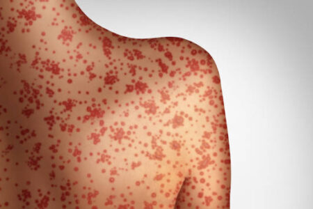 Interior Health reminds parents about the importance of measles immunizations